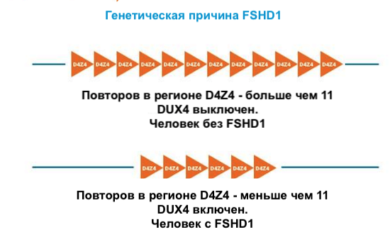 FSHD1 genetic reason DUX4 repeats in region D4Z4