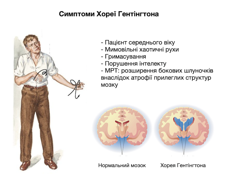 Хорея Гентінгтона симптоми